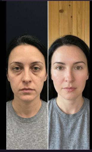 Medifube Korean PDRN Collagen Under Eye Patches