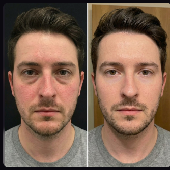 Before and after comparison supplied for Medifube